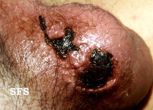 Fournier gangrene. Adapted from Dermatology Atlas.[34]