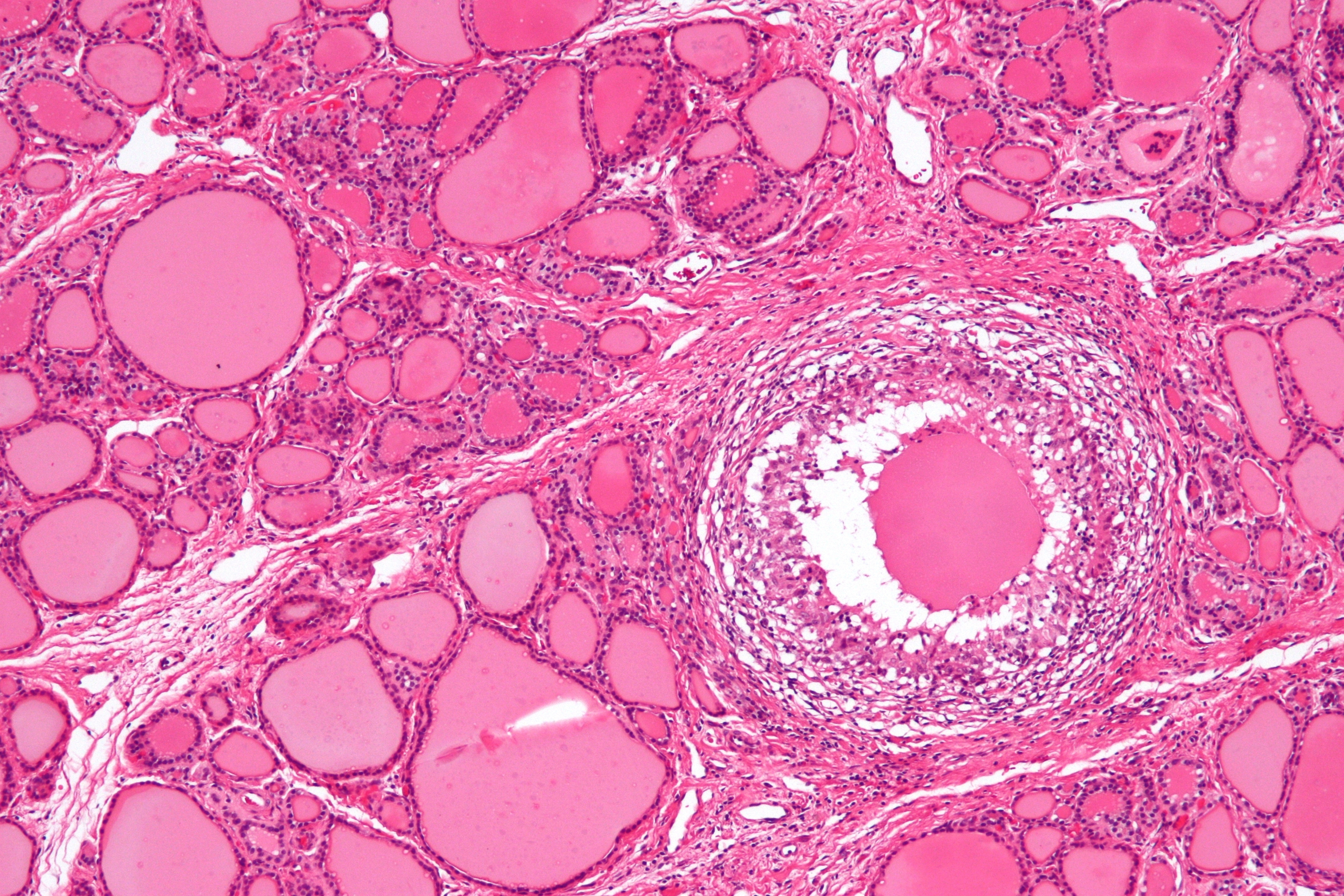 Histology of De Quervain's thyroiditis; Granuloma (By Nephron - Own work, CC BY-SA 3.0, https://commons.wikimedia.org/w/index.php?curid=18491382)