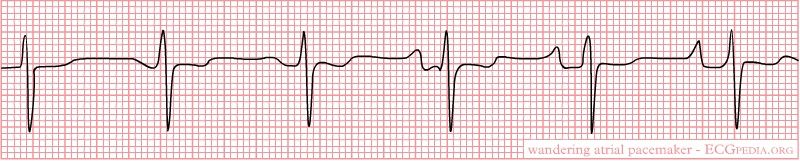 File:Wandering Atrial Pacemaker 1.png