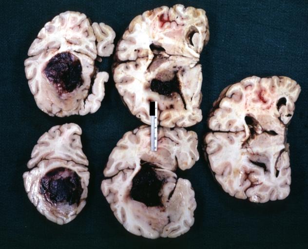 Brain: Oligodendroglioma: Gross; fixed tissue, multiple coronal sections, cerebral hemispheres with large tumor and hemorrhage into tumor