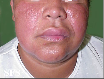 File:Melkersson rosenthal syndrome 01.png