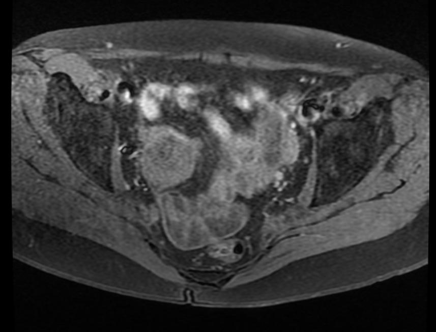 MRI: Ovarian fibroma.