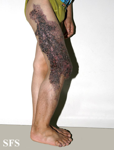 Klippel Trenaunay Syndrome. Adapted from Dermatology Atlas.[7]
