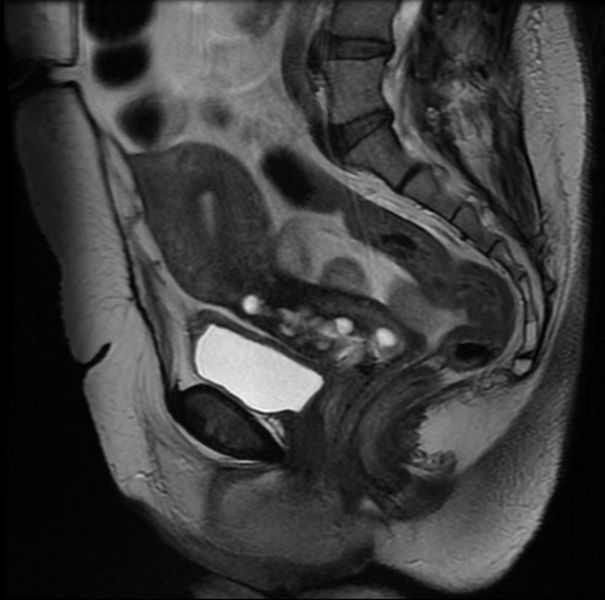 File:Large nabothian cysts MRI 004.jpg