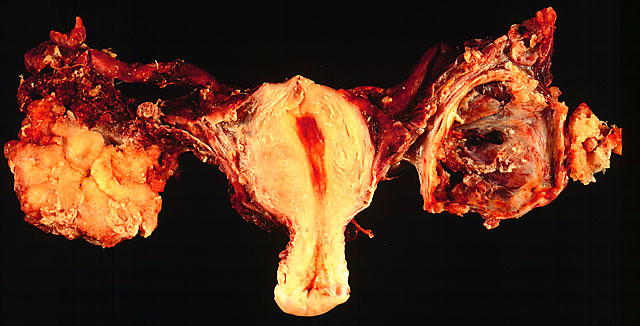 In this TAH-BSO specimen, the right ovary (on the left of the image) has been replaced by a solid serous carcinoma. The contralateral ovarian tumor is grossly cystic and could be termed a "cystadenocarcinoma." The patient had omental metastases and positive peritoneal fluid cytology. This cancer, which was discovered at exploratory laparotomy, apparently developed very rapidly; the patient had a normal pelvic ultrasound exam only 2 months before. (Courtesy of Ed Uthman, MD)