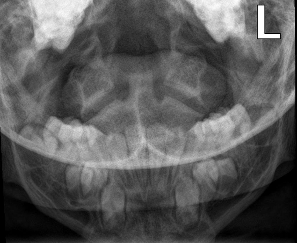 File:Achondroplasia (1).jpg