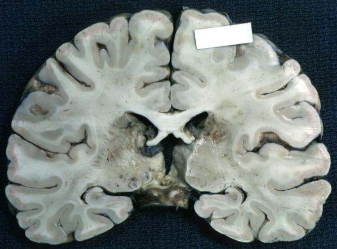 Brain: Cerebral Sarcoma or Microglioma: Gross; fixed tissue, coronal section, cerebral hemispheres (58 yo man)