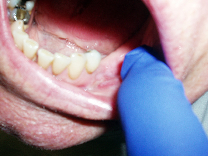 Squamous Cell Cancer of the Mouth: Cancer that began along the lower gum line has spread to left submandibular lymph nodes.