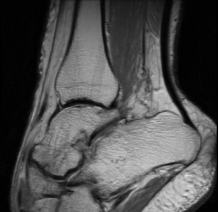 File:Hemophilia ankle MRI 104.jpg