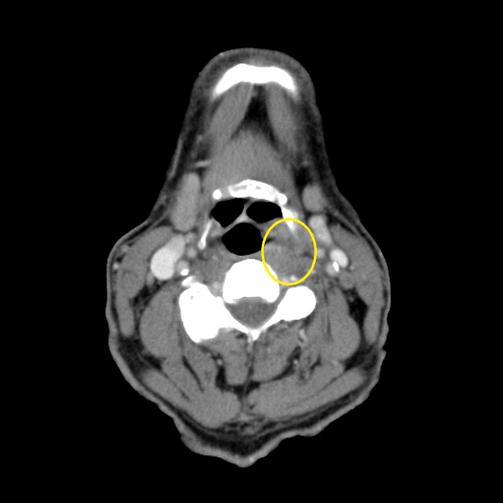 File:Hypopharyngeal-squamous-cell-carcinoma CT.jpg