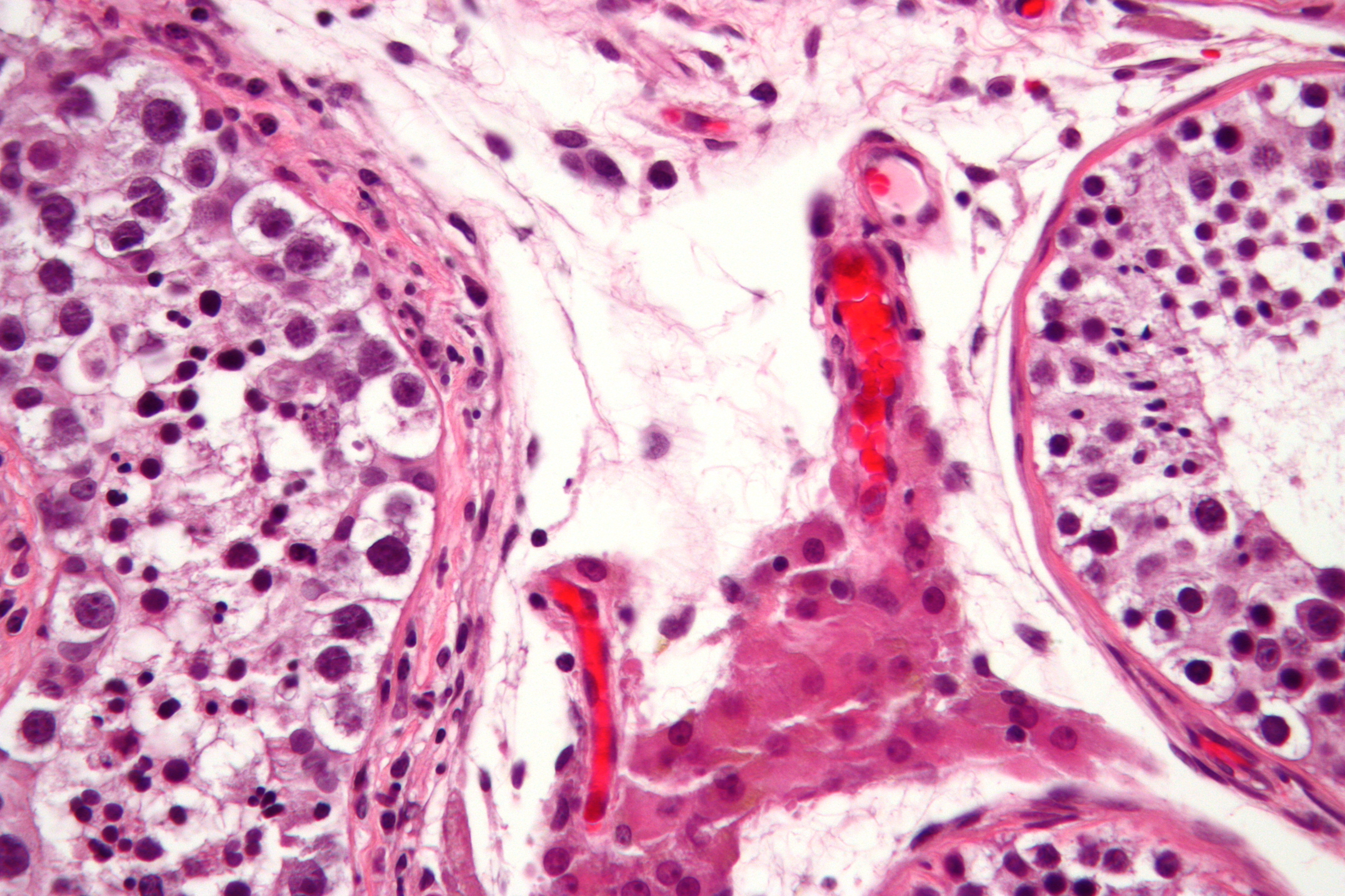 File:Intratubular germ cell neoplasia - 2 - very high mag.jpg