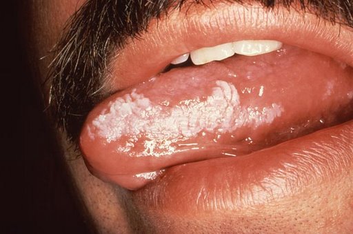 Oral Hairy Leucoplakia (EBV, HIV).