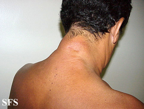 Reticular erythematous mucinosis. Adapted from Dermatology Atlas.[3]