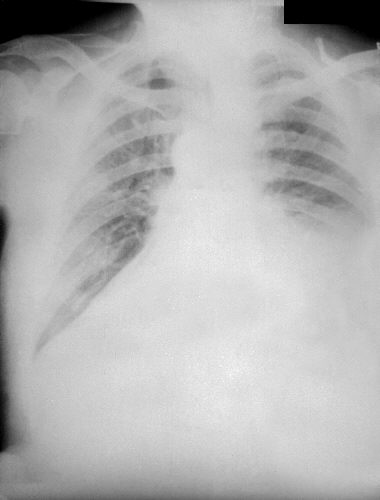 PA chest radiograph of anthrax, 4th day of illness. Adapted from Public Health Image Library (PHIL), Centers for Disease Control and Prevention.[3]
