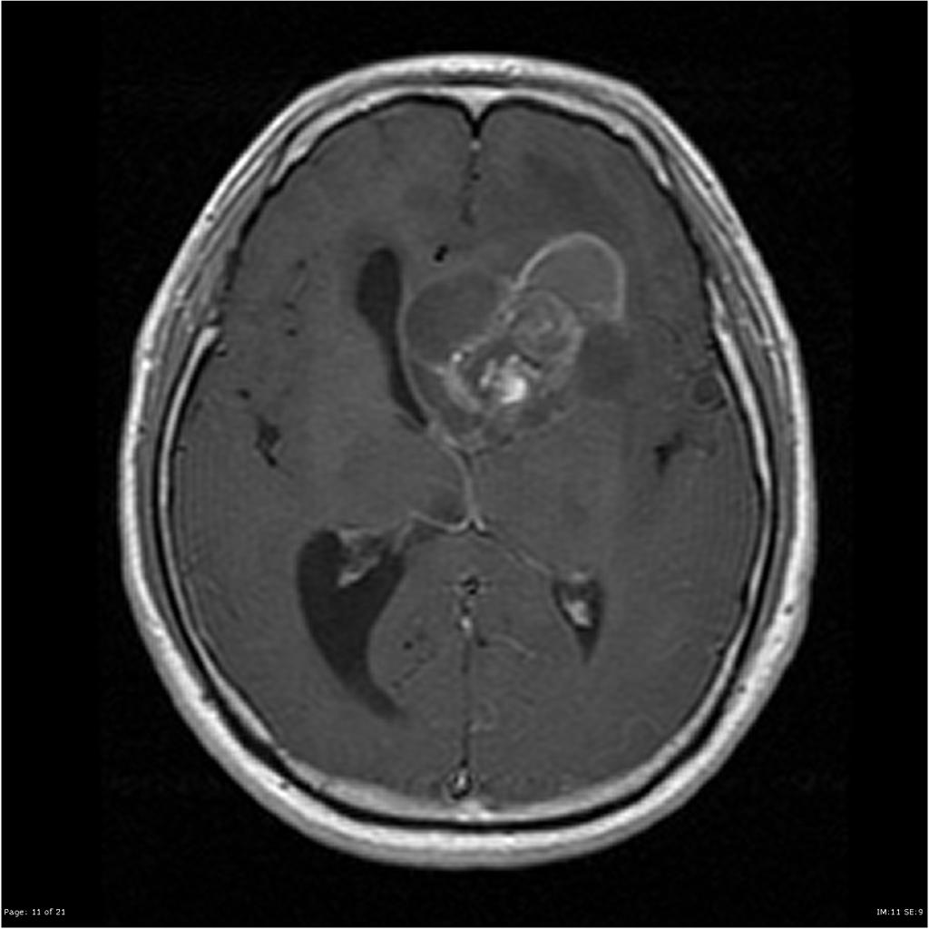 File:Ependymoma-lateral-ventricle(7).jpg