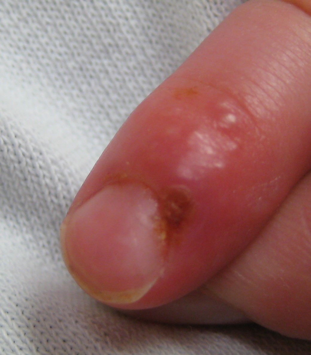 Herpetic whitlow in a young child who had earlier developed herpes gingivostomatitis