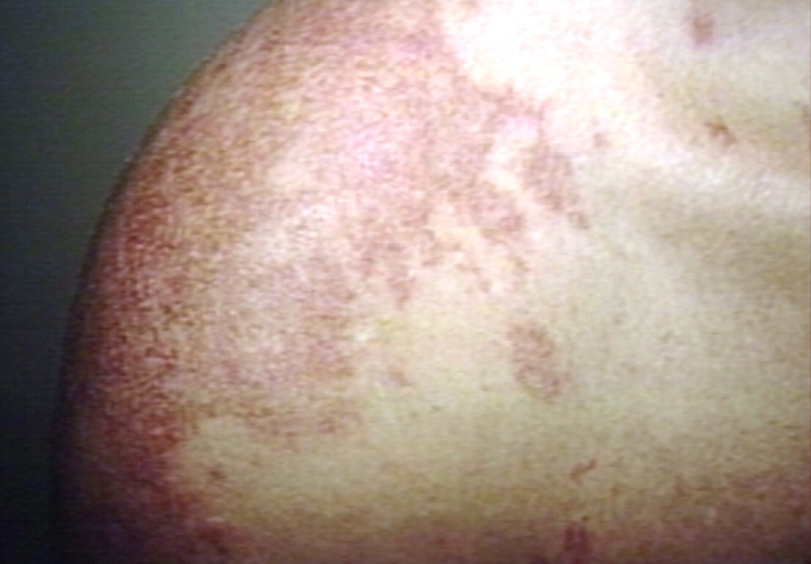 Skin: lupus, erythematosus, subacute; Papulosquamous diseases. Image courtesy of Professor Peter Anderson DVM PhD and published with permission © PEIR, University of Alabama at Birmingham, Department of Pathology.[26]