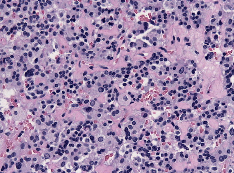 Pituitary adenoma of thyrotroph cells (TSH producing) - by Jensflorian source: Librepathology