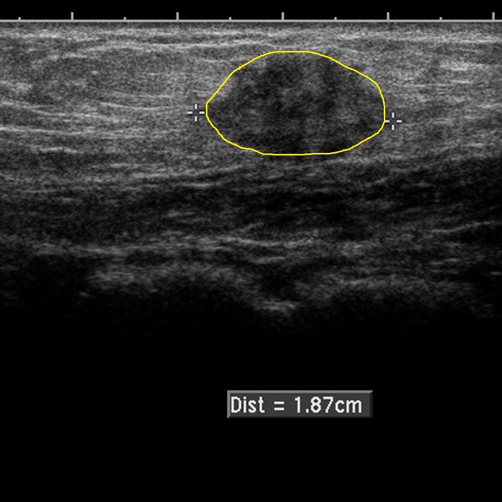 File:Endometriotic-deposit-antrior-abdominal-wall.jpg