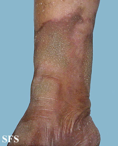 Progressive palmoplantar keratoderma. Adapted from Dermatology Atlas.[1]