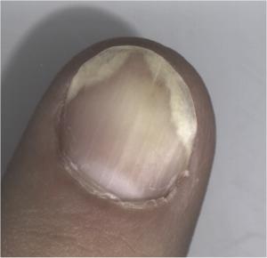 File:Psoriasis fingernail.jpg