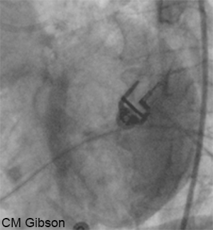 TMPG 1 left coronary artery