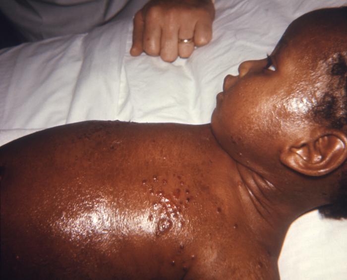 Child developed a case of eczema vaccinatum after having received a smallpox vaccination. Adapted from Public Health Image Library (PHIL), Centers for Disease Control and Prevention.[3]