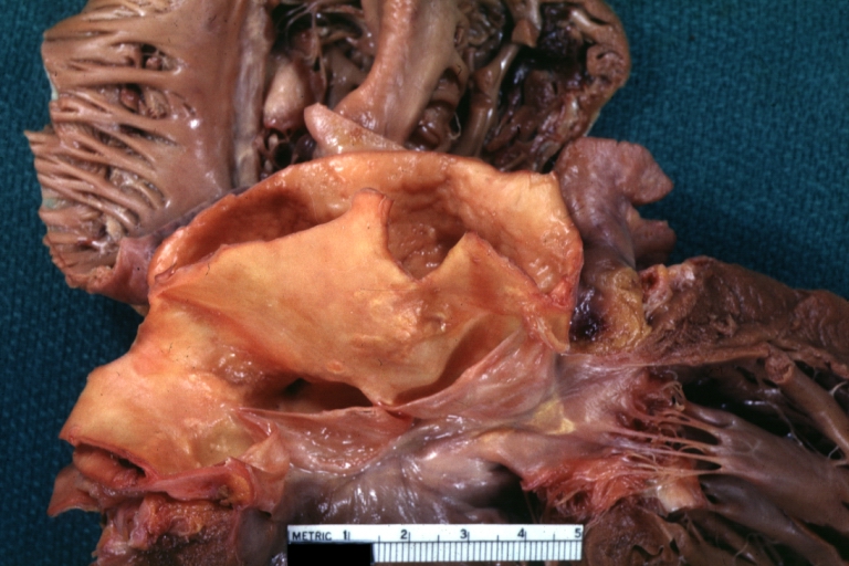 Dissecting Aneurysm Chronic: Gross, natural color, closer view of the previous one (a very good example)