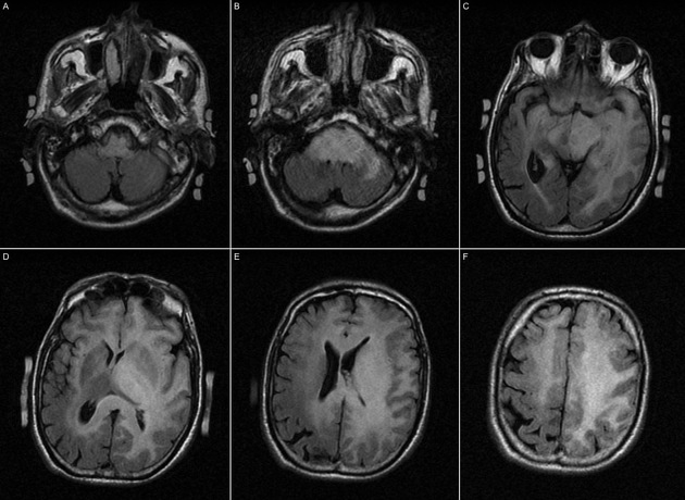 Axial FLAIR gliomatosis cerebri MRI.[3]