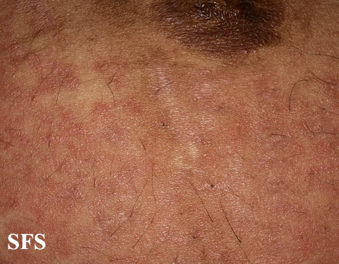 Pruritic urticarial papules and plaques of pregnancy. With permission from Dermatology Atlas.[7]