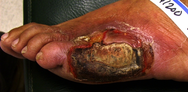 Diabetic ulceration with central "dry" gangrene and toward the edges wet gangrene with some ascending cellulitis (Image courtesy of Charlie Goldberg, M.D., UCSD School of Medicine and VA Medical Center, San Diego, CA)