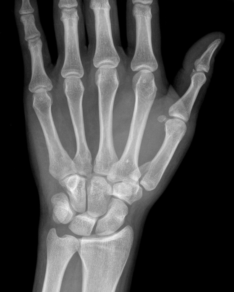 Intra-articular fracture and dislocation of the base of the 1st metacarpal.