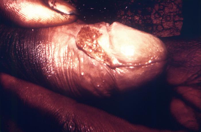 This image depicts the penis of a male patient who had presented with a lesion located on the lateral preputial skin just proximal to the corona of the glans. The lesion was characterized as a penile granulomata, due to a case of Donovanosis, or granuloma inguinale. From Public Health Image Library (PHIL). [5]