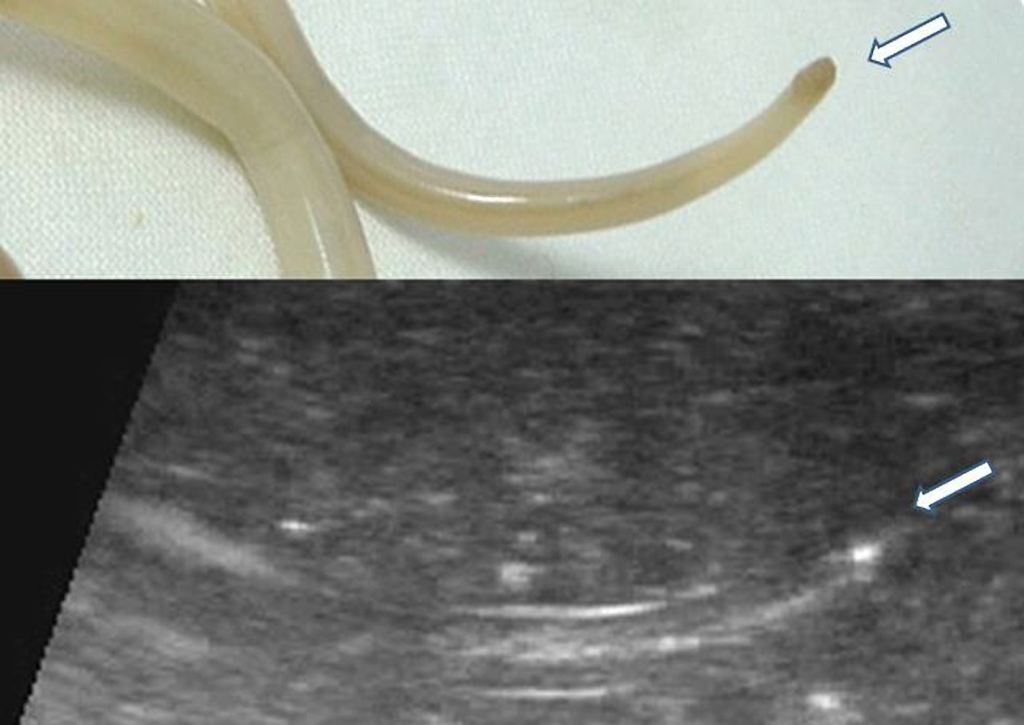 File:Intestinal nematode- Ascaris lumbricoides.jpg