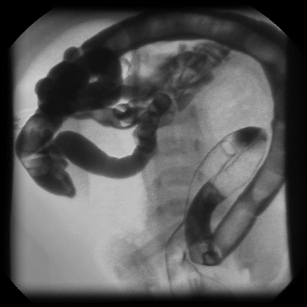 File:Meconium-ileus-neonate-with-cystic-fibrosis - Case courtesy of Dr Michael Sargent, Radiopaedia.org, rID 6009.jpg