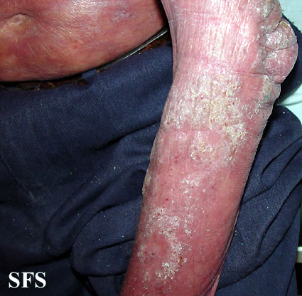 File:Mycosis fungoides 08.jpg