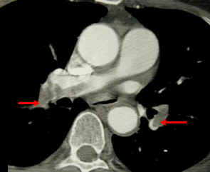 CT pulmonary angiogram. Clots in both the left and the right pulmonary arteries (red arrows). Source