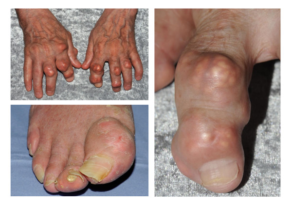 File:Tophaceous gout-Rt-great-toe.jpg