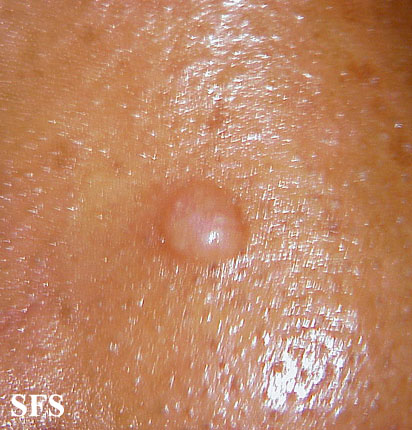 Trichofoliculoma. Adapted from Dermatology Atlas.[3]