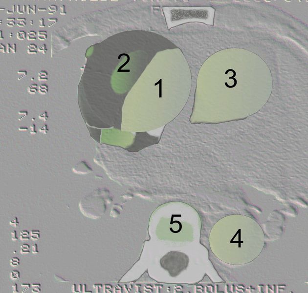 Aortic dissection Type Stanford A - '1 Aorta ascendens, true Lumen - 2 false Lumen - 3 Pulmonary artery - 4 Aorta descendens - 5 thoracic vertebra
