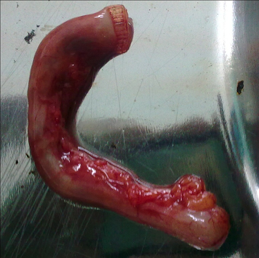 File:Appendicitis-gross-pathology.png