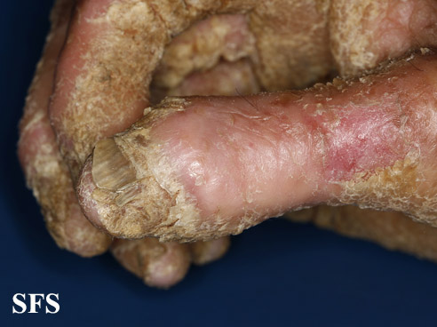 File:Darier's disease57.jpg