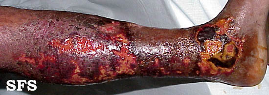 File:Eczema microbic05.jpg