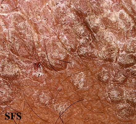Pityriasis rubra pilaris. With permission from Dermatology Atlas.[4]