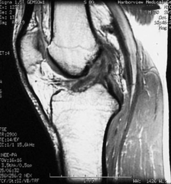 File:Segond-fracture-with-ACL-tear-005.jpg