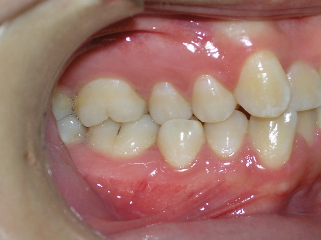 Before Orthodontic treatment (Lateral view)