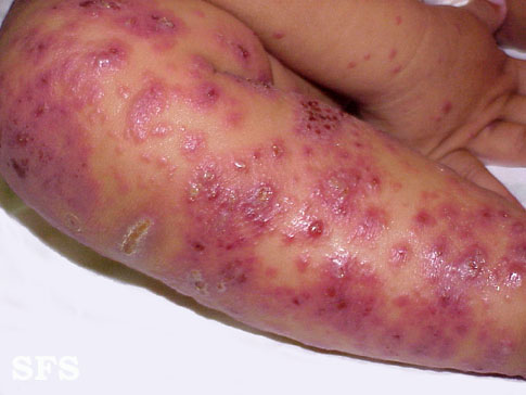 File:Eczema herpeticum05.jpg