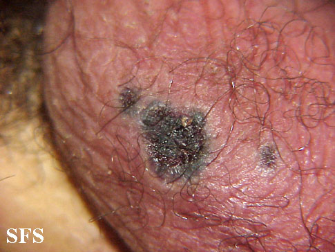 Fournier gangrene. Adapted from Dermatology Atlas.[34]
