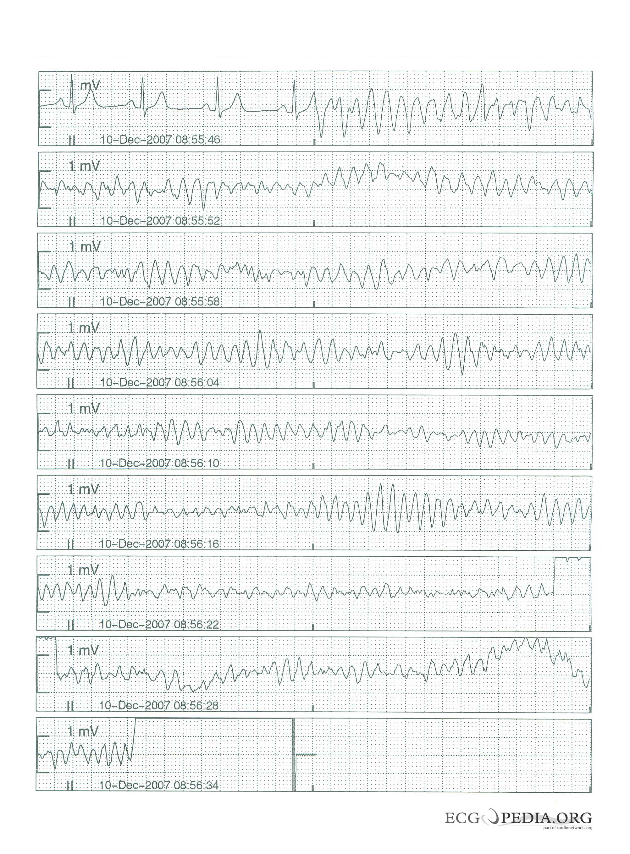 Arrhythmias in a patient with short coupled torsades de pointes degenerating in ventricular fibrillation[1]