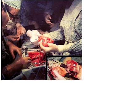 Historical Operation, the first in medical history. Total heart Replacement with an Artificial Heart (orthotopic position, inside the pericardial sac). On the left, Dr. Liotta; in the center of the picture, the empty pericardial sac of the patient, Mr. H. Karp. On the right, the hands of Dr. Cooley holding Mr. Karp’s heart and the artificial heart just before implantation. Texas Heart Institute, Houston (April 4 1969)Corner picture: Dr. Cooley is holding both the removed artificial heart and the donor heart. (April 7, 1969).